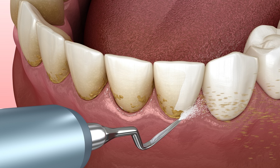Профилактика и лечение зубного налета