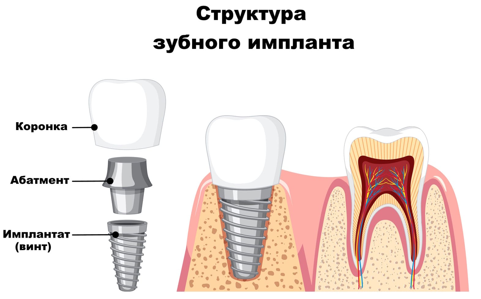 Виды зубных имплантатов и их преимущества