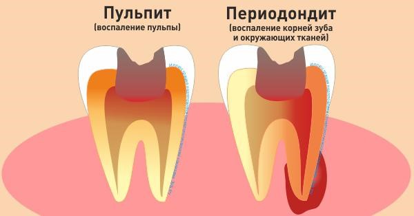 Периодонтит — воспаление вокруг корня Периодонтит — воспаление вокруг корня