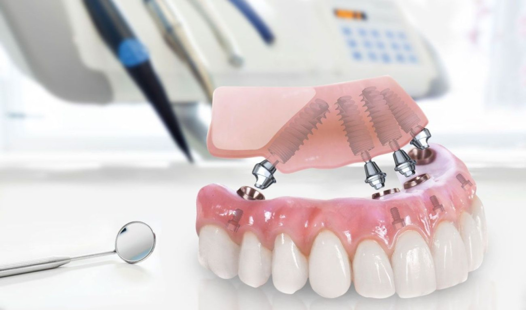 All-on-4 или All-on-6